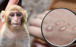 Thấy da nổi những nốt phát ban thế này, cần cảnh giác với bệnh đậu mùa khỉ