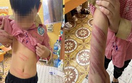 Hải Phòng: Làm rõ vụ bé trai 8 tuổi bị bạn trai của mẹ bạo hành