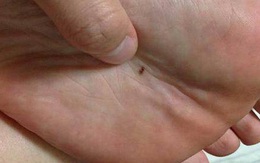 2 hiện tượng bất thường xuất hiện ở lòng bàn tay, lòng bàn chân cảnh báo tế bào ung thư đang nhen nhóm phát triển