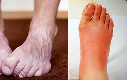 4 biểu hiện ở bàn chân cho thấy bạn cần đến gặp bác sĩ càng sớm càng tốt