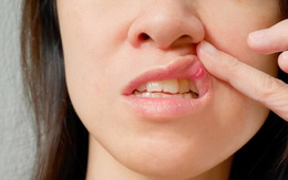 4 hiện tượng xuất hiện ở vùng miệng cho thấy gan đang có vấn đề, đừng chủ quan kẻo hối hận không kịp
