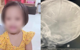 Nóng: Bé gái 3 tuổi bị đinh găm vào đầu đã tử vong sau gần 2 tháng điều trị