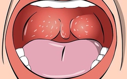 3 triệu chứng xuất hiện ở cổ họng ngầm cảnh báo phổi đang bị tổn thương, ngay từ điều đầu tiên đã rất đáng lo