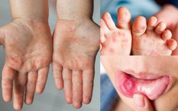 Con sốt 40 độ, không nổi nốt đỏ nên cha mẹ tưởng mọc răng, đi khám tá hoả đã mắc bệnh tay chân miệng độ 2: Cảnh báo những triệu chứng dễ nhầm lẫn với bệnh thông thường