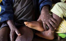 Châu Phi công bố 103 ca tử vong do đậu mùa khỉ, cảnh báo đường lây khác