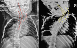 Bé trai 6 tuổi bị biến dạng vẹo lệch cột sống - lời cảnh báo cho các bậc cha mẹ