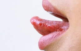 5 dấu hiệu ở lưỡi cảnh báo cả loạt bệnh nguy hiểm đang cận kề, từ bệnh gan, đột quỵ tới ung thư