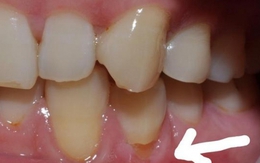 Răng vỡ rụng từng mảng vì cách đánh răng sai nhiều người mắc