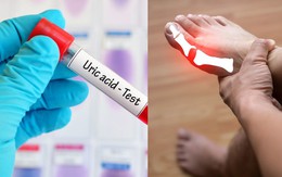 10 cách 'đào thải' acid uric một cách tự nhiên, ngừa gout hiệu quả: Nhiều người chưa biết để làm