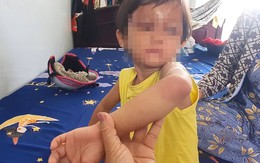 Làm rõ vụ bé gái 4 tuổi bị cha nuôi đánh gây thương tích