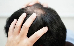 Rụng lông tóc ở ba vùng trên cơ thể có thể là dấu hiệu của bệnh truyền nhiễm