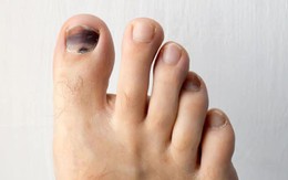 Người gan kém thường gặp 3 vấn đề này ở bàn chân, mong rằng bạn không có dù chỉ là 1 điểm