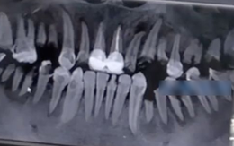 Chàng trai 23 tuổi răng bị ăn mòn, gãy gần hết cả hàm vì loại đồ uống giới trẻ không ai là không thích
