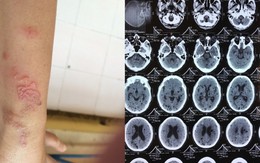 Tưởng bị đột quỵ, người đàn ông chữa mất 2 năm mới phát hiện có ấu trùng sán dây trong não