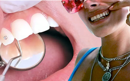 Xu hướng đính đá vào răng: Bác sĩ khuyến cáo điều quan trọng khi làm