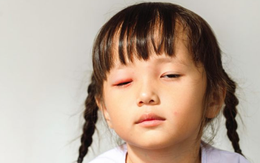 Bệnh đau mắt đỏ lây nhanh ở trẻ dưới 5 tuổi