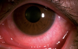 Đau mắt đỏ có thể biến chứng nguy hiểm, mất thị lực vĩnh viễn