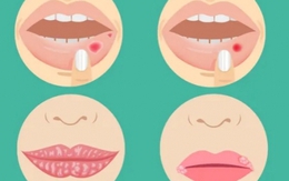 4 dấu hiệu bệnh nghiêm trọng có thể xuất hiện ở môi: Nếu thấy cần đi khám ngay