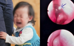 Bé gái 13 tháng tuổi ở Bình Thuận khóc dữ dội sau khi tắm suối, gia đình tá hỏa khi thấy sinh vật lạ lấp ló trong lỗ mũi