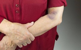 Bất kể nam hay nữ, nếu có 2 triệu chứng sau ở cánh tay thì có thể là ung thư, nên đi khám và điều trị càng sớm càng tốt