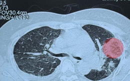 Người phụ nữ ở Hà Nội có phổi đông đặc, tổn thương lỗ chỗ: BS cảnh báo nguy cơ từ căn bệnh lây qua muỗi