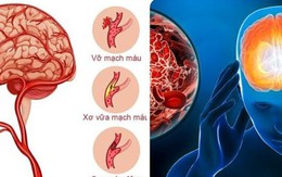 7 dấu hiệu cảnh báo cơn đột quỵ sắp xảy ra