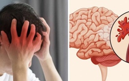 Sinh viên 22 tuổi đột quỵ lúc 4 giờ sáng phải lên bàn mổ ngay lập tức: Những dấu hiệu DỄ THẤY và ĐƯỢC BÁO TRƯỚC, nhưng bị xem nhẹ