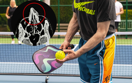 Người đàn ông TP.HCM gãy xương mũi vì chơi Pickleball