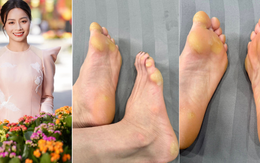 Bàn chân biến dạng của hot girl bóng đá Hoàng Thị Loan gây xôn xao