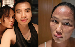 Hoa hậu H'Hen Niê sau khi bị biến dạng mặt