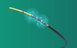 Ứng dụng công nghệ phá vôi lòng mạch mới điều trị hẹp mạch vành phức tạp