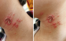 Bé trai 10 tuổi bỗng xuất hiện những nốt mẩn lạ trên da nhưng vẫn chưa tìm ra được nguyên nhân