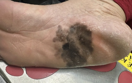 Đốm đen trên da có phải là dấu hiệu ung thư da?