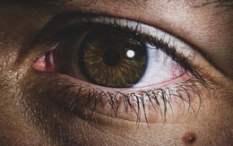 Tưởng nốt ruồi lộc trên mắt hoá ra mắc UNG THƯ DA, bác sĩ sửng sốt: Sai lầm chết người khi coi thường một ‘dấu chấm nhỏ’