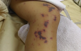 TP.HCM phát cảnh báo bệnh não mô cầu, Hà Nội ghi nhận thêm 1 trường hợp