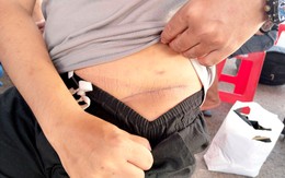Nam thanh niên sang Campuchia làm “việc nhẹ lương cao” bị cưỡng ép cắt bỏ một quả thận: Vết sẹo dài bên mạn sườn gây ám ảnh