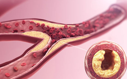 3 "kẻ thù" giấu mặt đang âm thầm bóp nghẹt mạch máu mỗi ngày, đột quỵ dễ ập đến bất ngờ