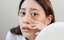 Loạt dấu hiệu trên da cho thấy gan đang suy yếu, cần đi khám ngay Loạt dấu hiệu trên da cho thấy gan đang suy yếu, cần đi khám ngay
