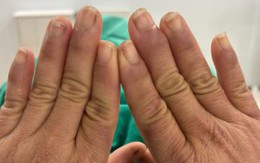 Người phụ nữ đau đớn mỗi khi chạm tay vào nước, đi khám ngỡ ngàng khi nhận kết quả Người phụ nữ đau đớn mỗi khi chạm tay vào nước, đi khám ngỡ ngàng khi nhận kết quả