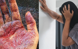 Hạt vi nhựa cao gấp 150 lần ở người đột quỵ so với người khỏe mạnh: Có 6 mẹo hay giảm hấp thụ