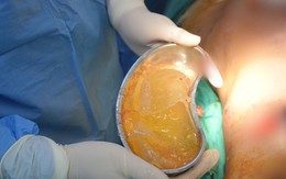 Người phụ nữ vỡ túi ngực khi đang mang thai