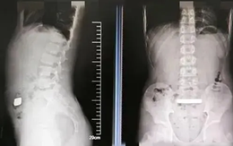 Cậu bé 11 tuổi "nuốt thỏi vàng 100 gam" vào bụng, bác sĩ lo lắng cảnh báo, cư dân mạng lại có phản ứng bất ngờ