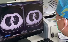 Cảm lạnh và ho, phổi trái của nam sinh đột nhiên "biến mất": Bác sĩ tiết lộ nguyên nhân nhiều người phải cẩn thận