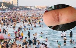 Người đàn ông bỏng rát toàn bộ chân trái sau 15 phút tắm biển