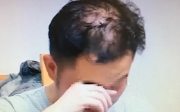 Nam sinh 16 tuổi đã hói nửa đầu vì 1 thói quen khi ngủ người càng trẻ tuổi càng dễ “sa vào bẫy”