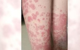 Nữ sinh trả giá đắt vì nhuộm tóc liên tục: Thận chảy máu, phải cạo đầu giữ mạng Nữ sinh trả giá đắt vì nhuộm tóc liên tục: Thận chảy máu, phải cạo đầu giữ mạng