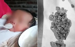 Bé gái 5 tháng tuổi đến viện với chiếc bụng toàn sỏi, bác sĩ kinh hoàng khi biết việc bố mẹ làm từ lúc bé mới sinh 3 ngày Bé gái 5 tháng tuổi đến viện với chiếc bụng toàn sỏi, bác sĩ kinh hoàng khi biết việc bố mẹ làm từ lúc bé mới sinh 3 ngày