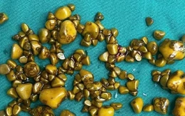 Người phụ nữ 'giấu cả trăm cục vàng' trong... túi mật