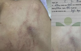 NÓNG - Vụ bé gái 4 tuổi bị cô giáo ném vào tường, đánh tím lưng: Bộ Y tế vào cuộc!