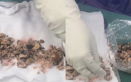 Thấy thứ được lấy ra từ 2 quả thận của bệnh nhân, bác sĩ thốt lên: ‘Sức chịu đựng quá phi thường’